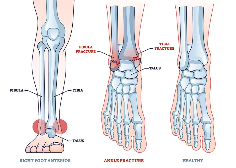 ankle fractures in need of repair