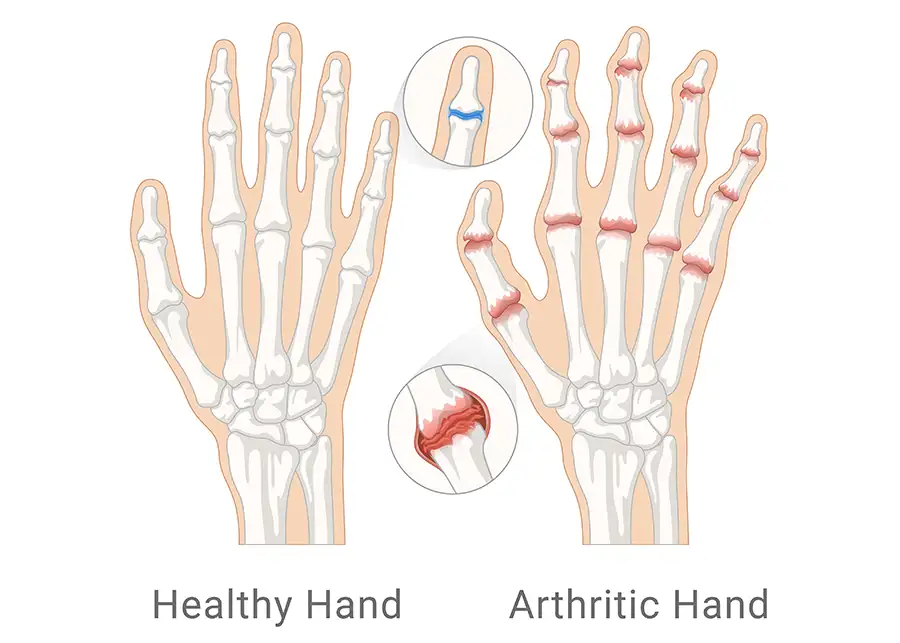 hand/wrist arthritis diagram of right hand