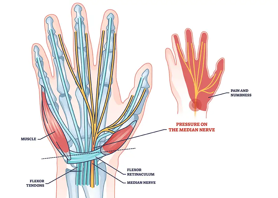 diagram of Carpal Tunnel Syndrome