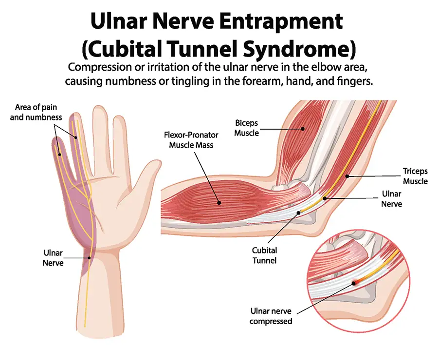 diagram of elbow and hand cubital tunnel syndrome