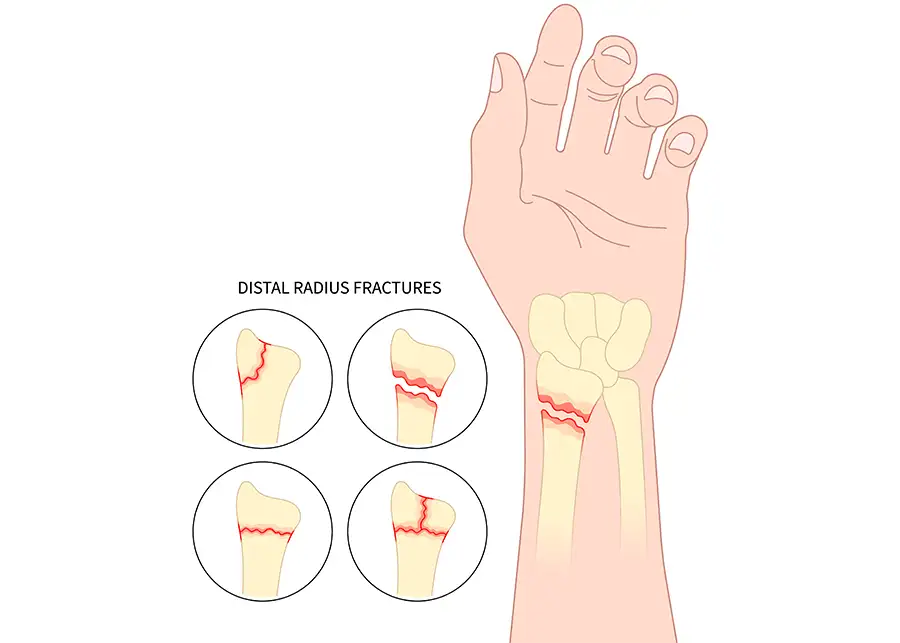 different distal radius fractures in the wrist of the left hand