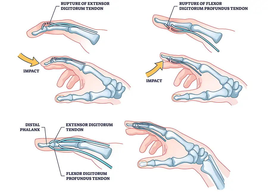 diagrams of Flexor & Extensor Tendon Injuries