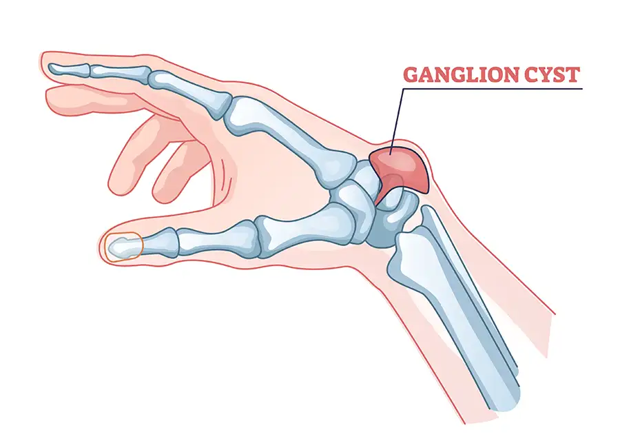 diagram of ganglion cyst on wrist joints of right hand