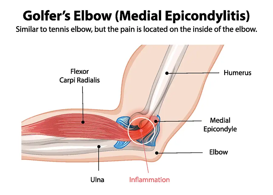 diagram of golfer's elbow condition