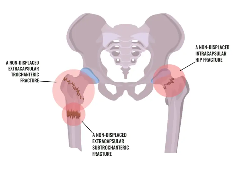 different types of hip fractures in need of repair