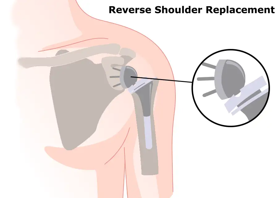 diagram of reverse total shoulder replacement - artificial shoulder joint