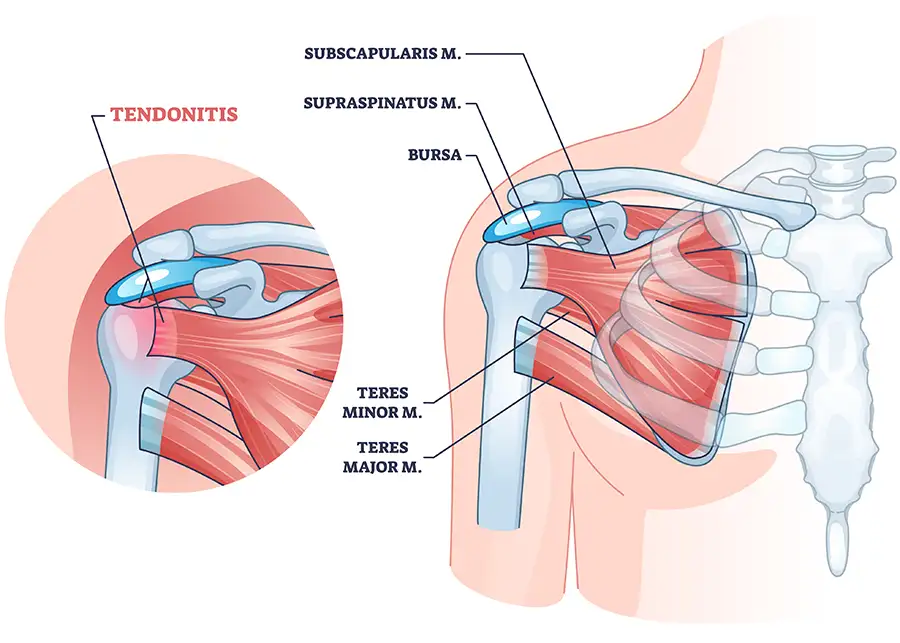 diagram of shoulder rotator cuff damage, pain, tendonitis, repair