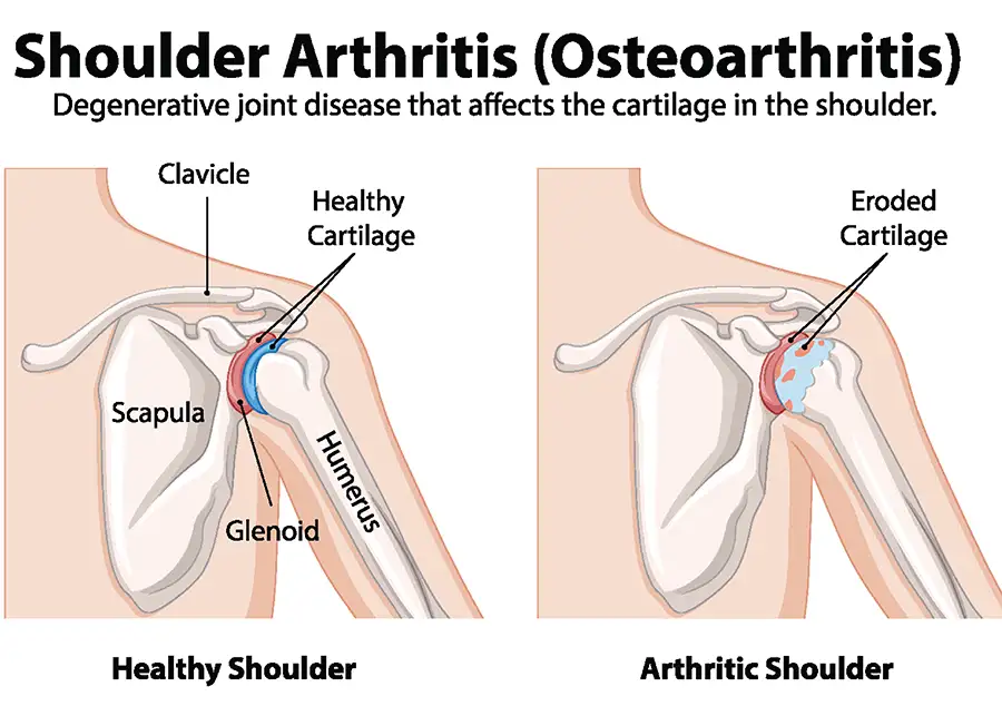 diagram of healthy shoulder and arthritic shoulder side by side