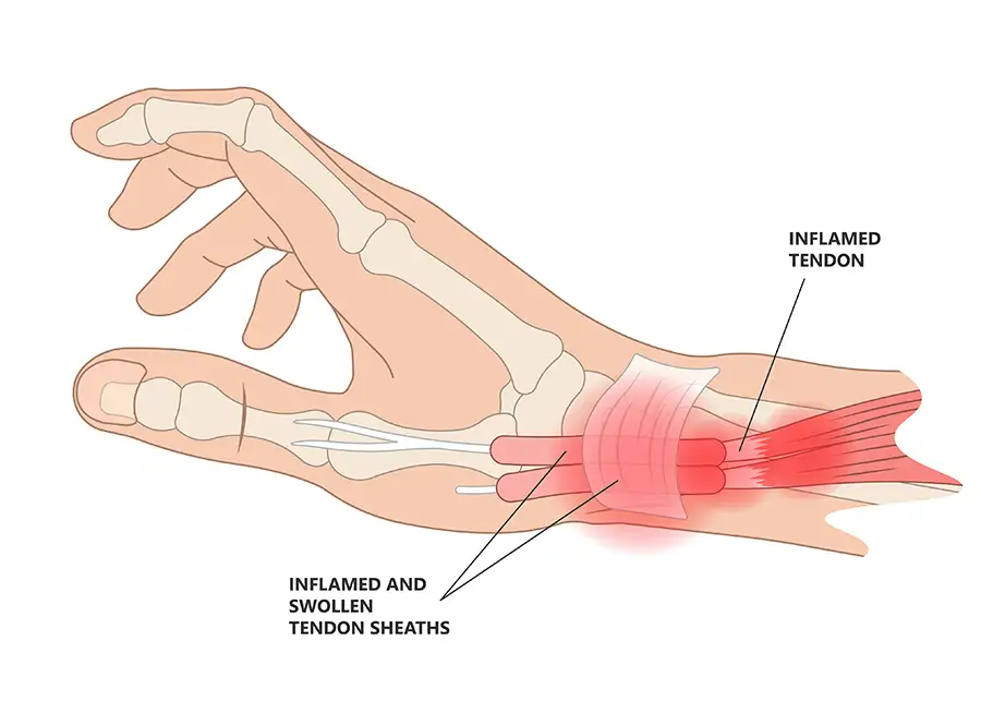 diagram of tendonitis of the right hand