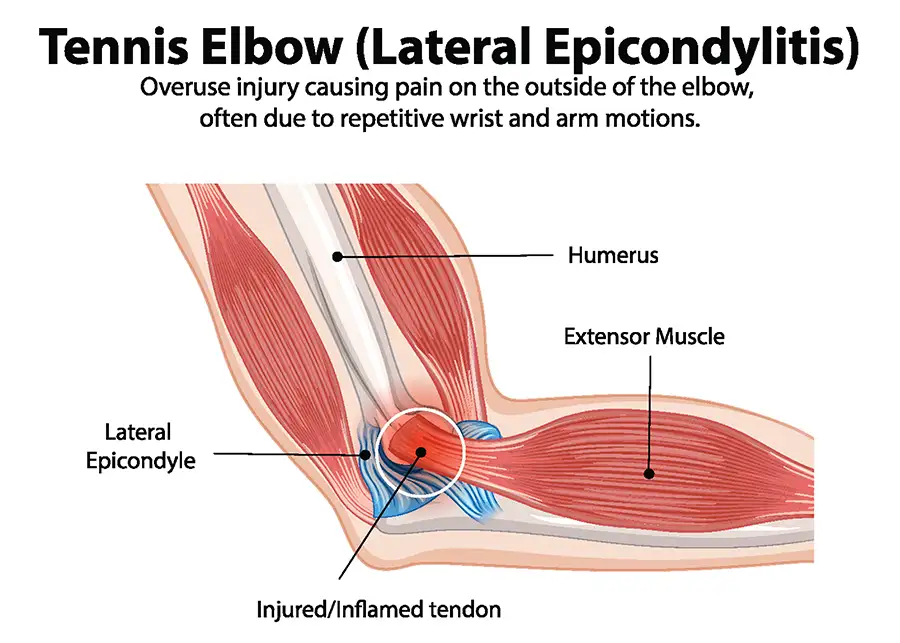 diagram of tennis elbow condition