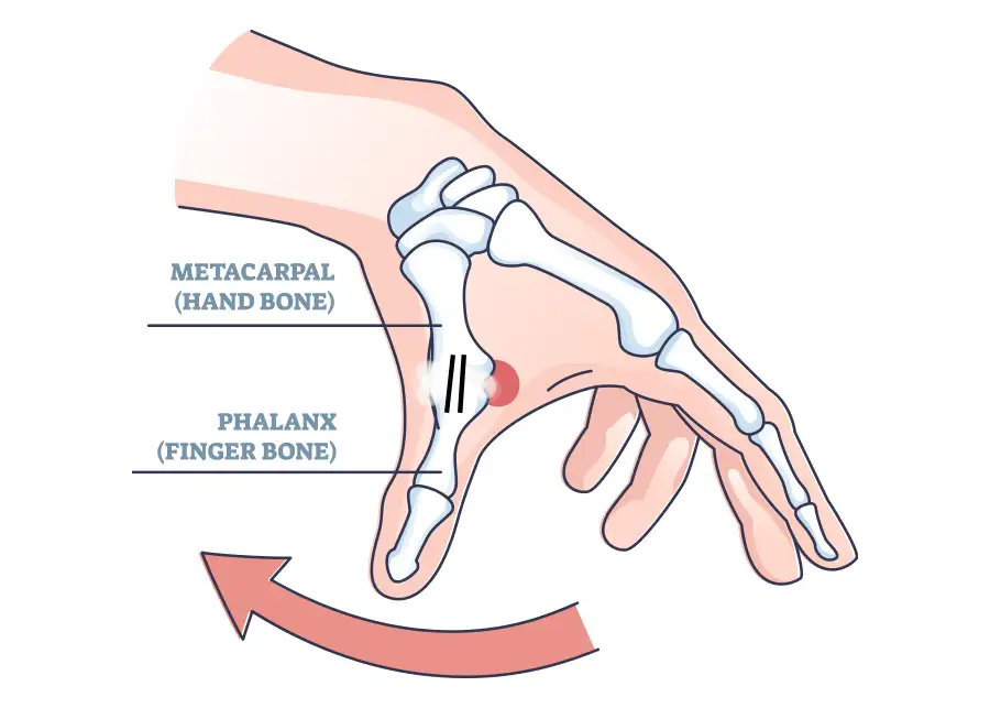 diagram of thumb fusion surgery on left hand