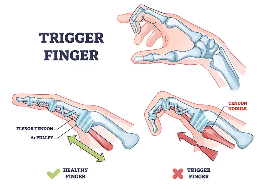 diagram of trigger finger condition